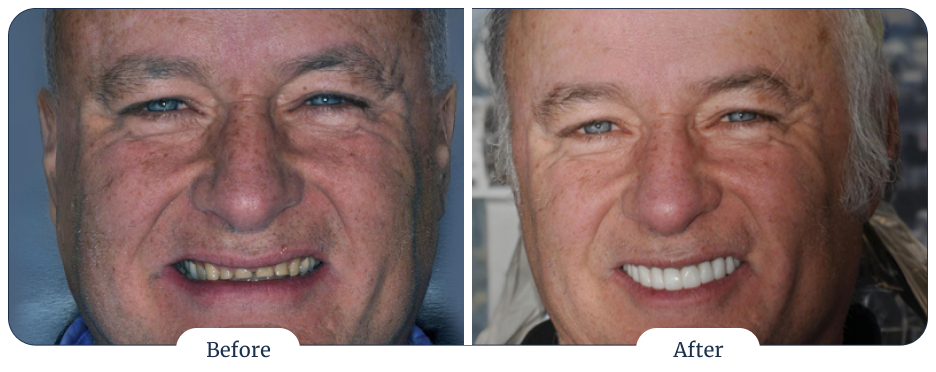 Dental-Implant-Centre_Missing-teeth